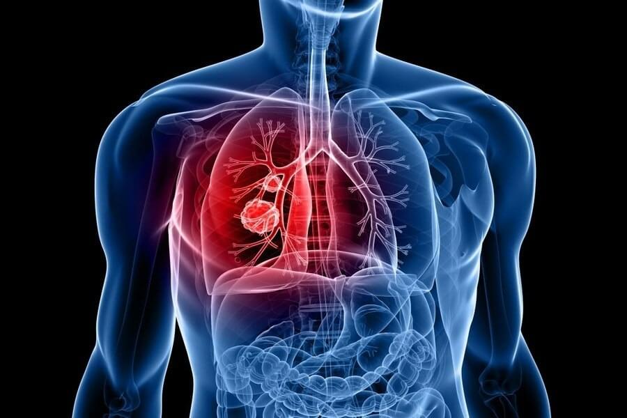 Akciğer kanseri dünyada en sık görülen kanser türüdür.